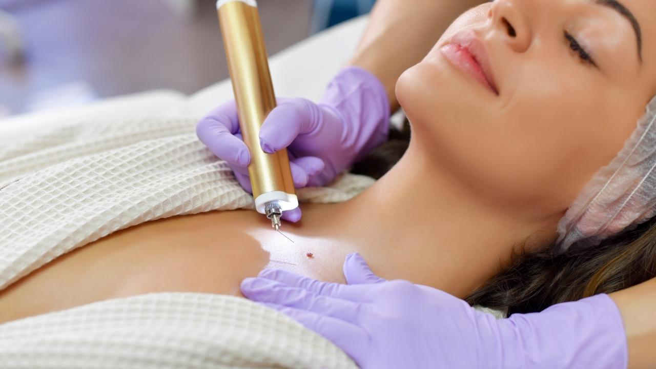 Skin Cyst Removal In Singapore