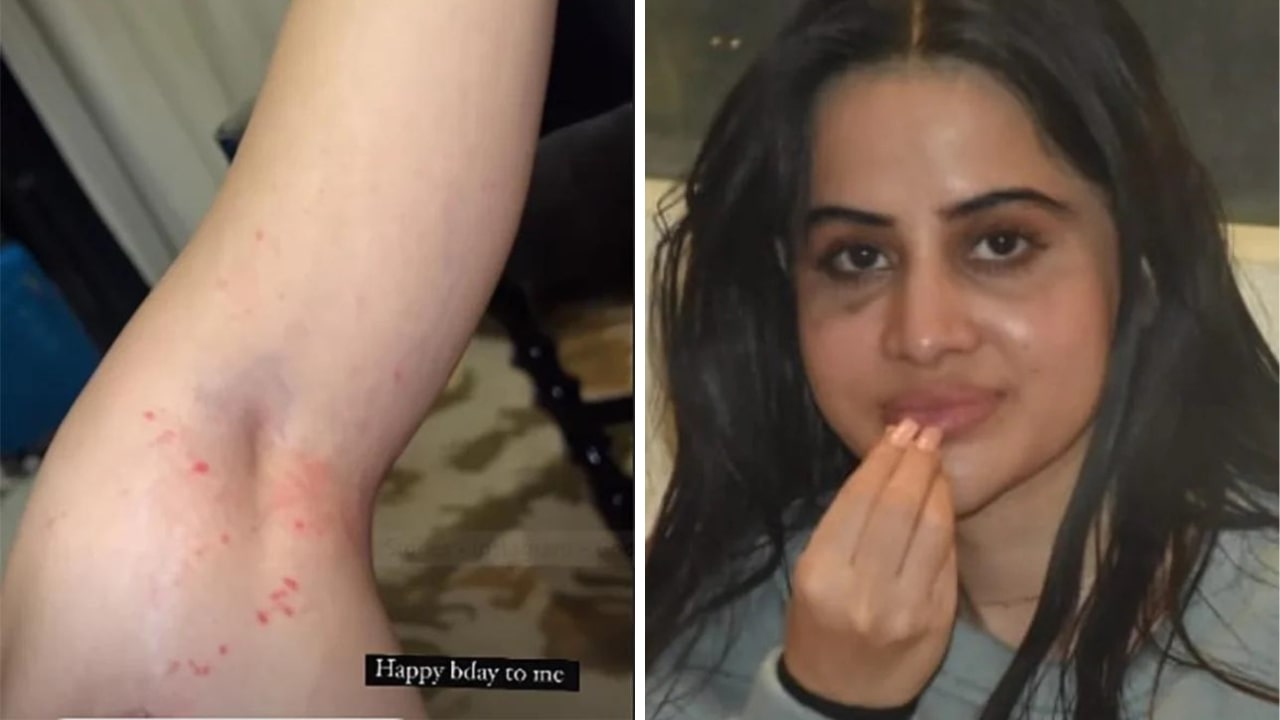 Urfi Javed Skin Allergy