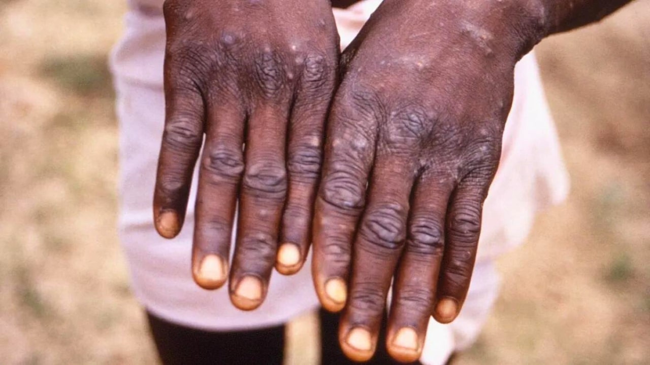 Mpox Symptoms