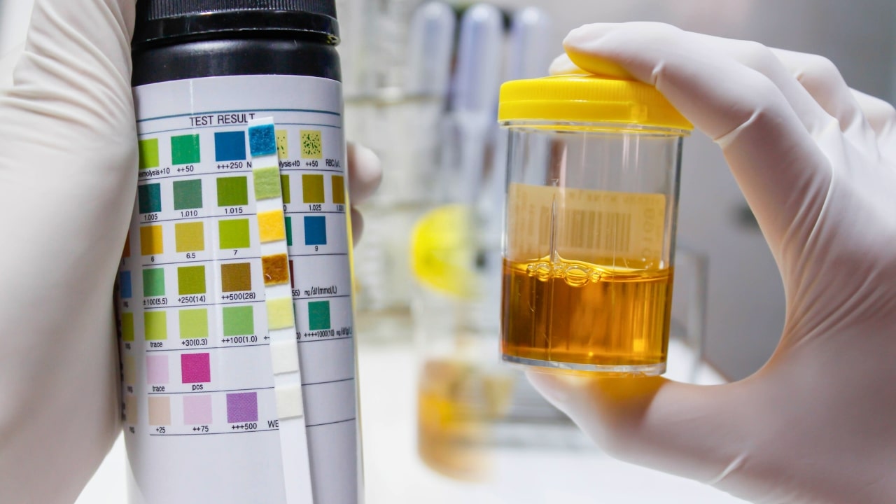 Urine Colour