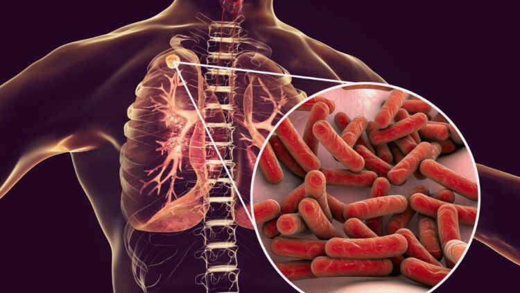 Tuberculosis